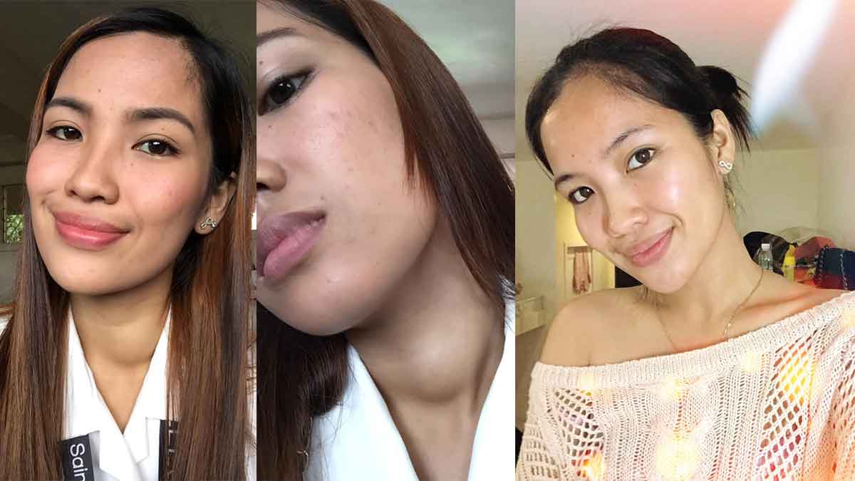 3 Months of Taking Luxxe White and Luxxe Protect Nawala ang Goiter