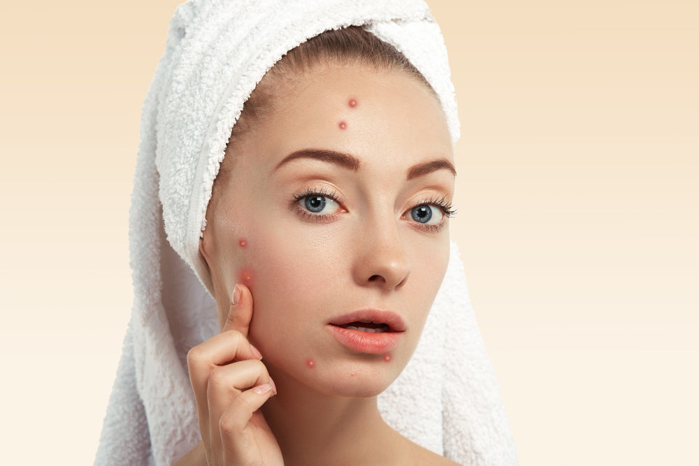 How To Get Rid Of Acne Fast And Easy