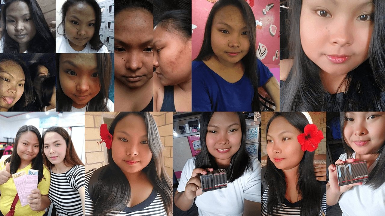 My Pimples Journey and How Frontrow Products Return My Confidence